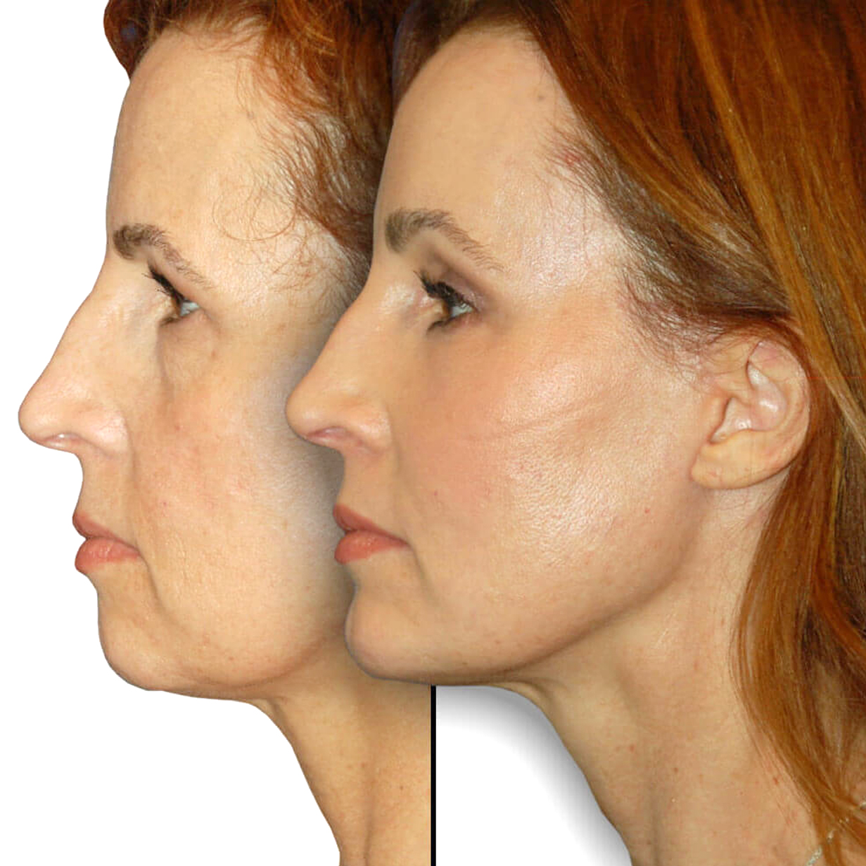 Blefaroplastia-perfexion